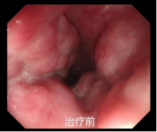 重度食管胃底静脉曲张的内镜下治疗病例二
