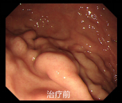 重度食管胃底静脉曲张的内镜下治疗病例一
